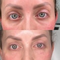 Can i have botox with polynucleotides?