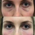 The Truth About Polynucleotide Treatments for Eyes: An Expert's Perspective