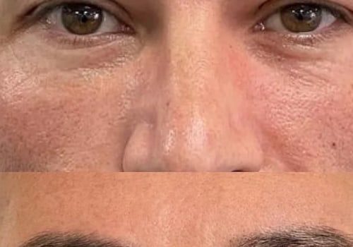 How many polynucleotide strands are in rna?