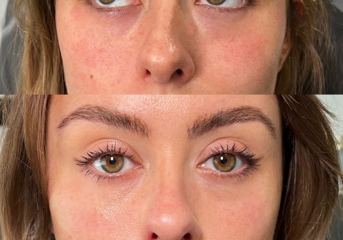 What does polynucleotide do for the face?