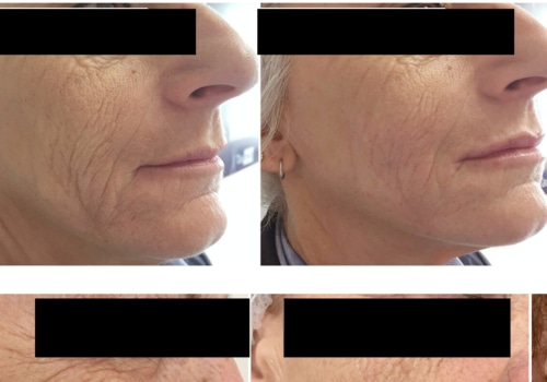 The Truth About Polynucleotides for Rosacea: An Expert's Perspective