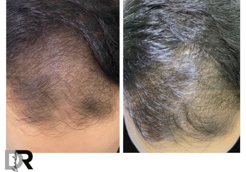 Do polynucleotides help hair growth?