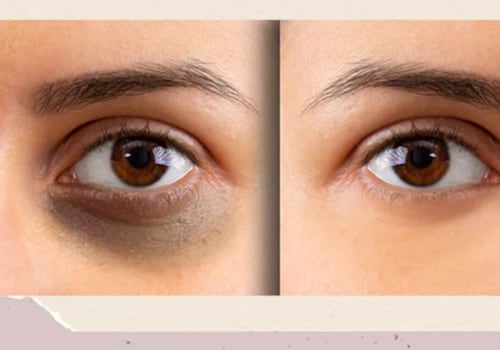 What vitamin deficiency causes eye bags?